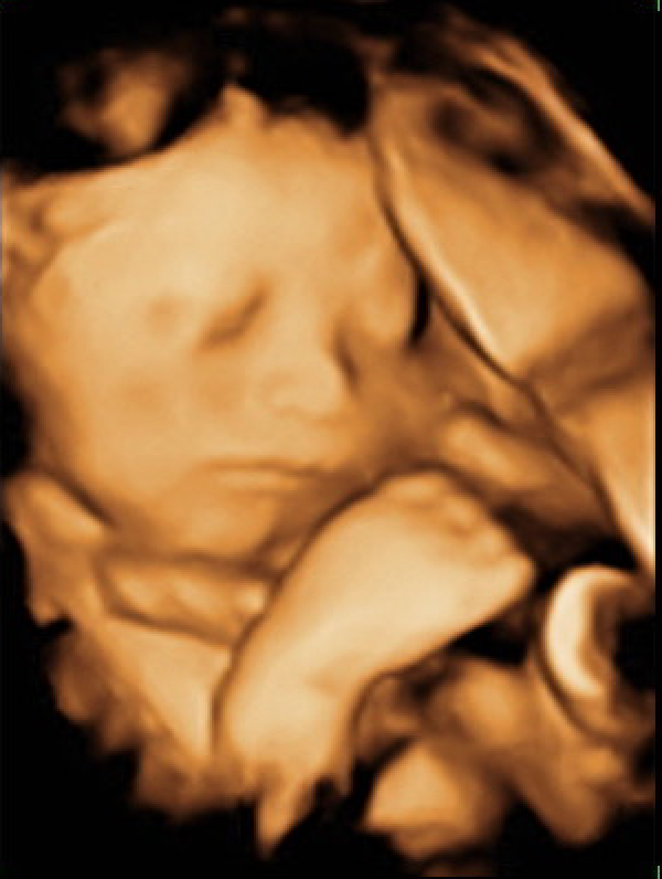 3D Ultra sound